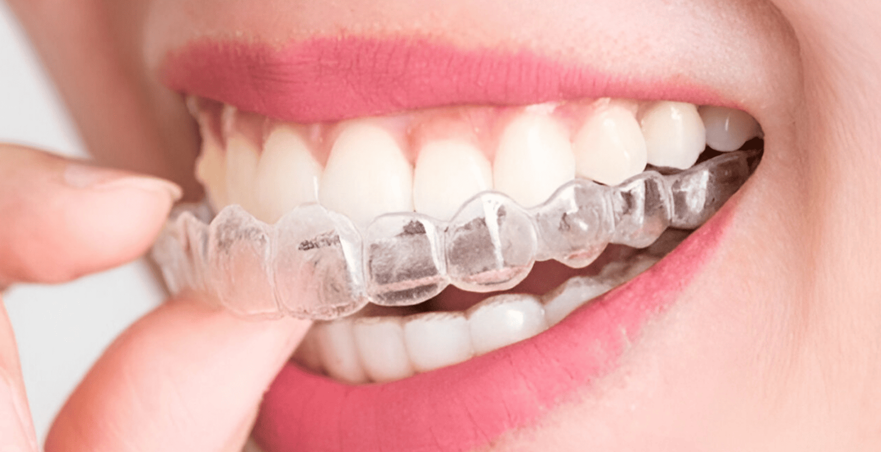 Clear Aligner